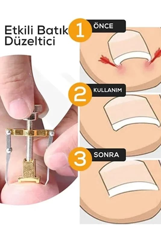 Ergonomik Paslanmaz Çelik Batık Tırnak Düzeltici Aparat