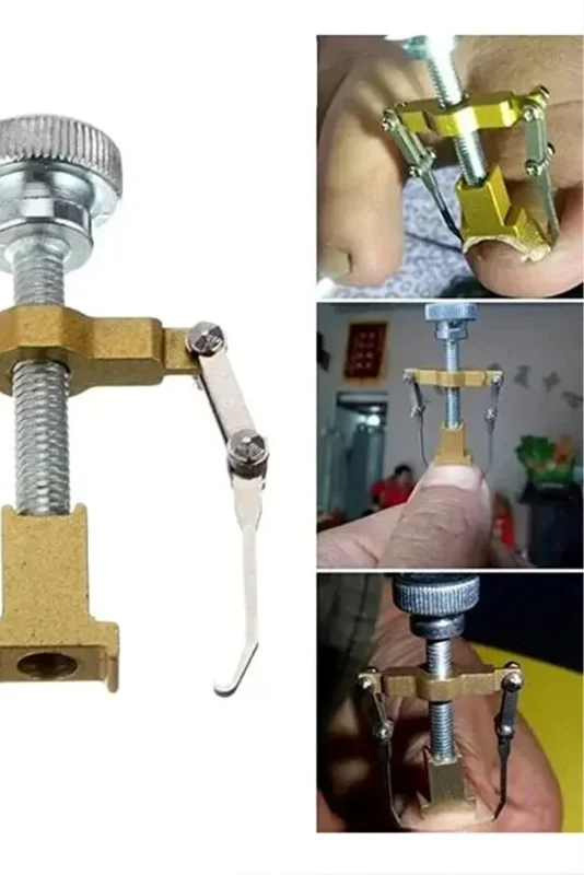 Ergonomik Paslanmaz Çelik Batık Tırnak Düzeltici Aparat