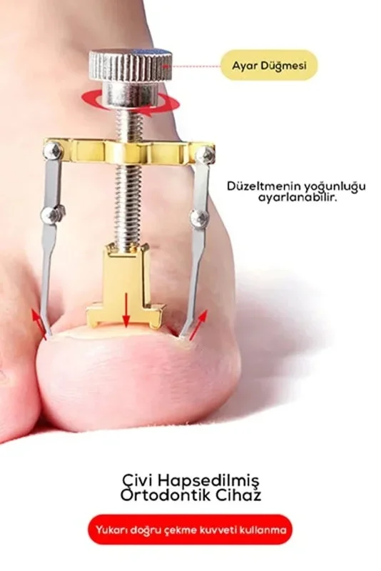 Ergonomik Paslanmaz Çelik Batık Tırnak Düzeltici Aparat